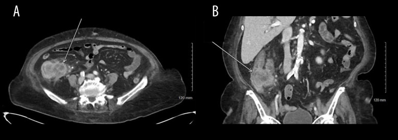 Sarcomatoid Carcinoma of the Ascending Colon: A Case Report and Literature Review.
