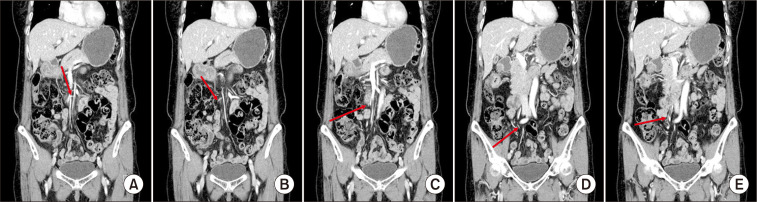 Ileal long-segment ischemia after the unintended ligation of variant ileal branch during laparoscopic right hemicolectomy.