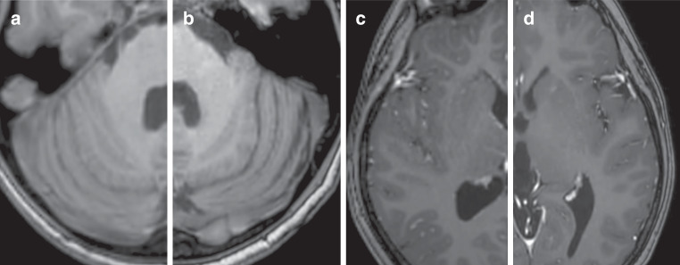 Compressed SENSE in Pediatric Brain Tumor MR Imaging : Assessment of Image Quality, Examination Time and Energy Release.