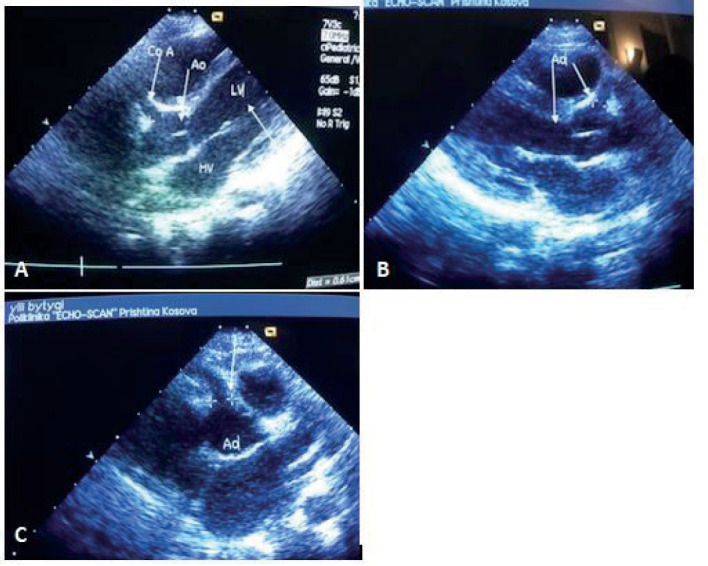 Kawasaki Disease Shock Syndrome Presented with Giant Coronary Artery Dilatation - Presentation of Two Cases and a Literature Review.