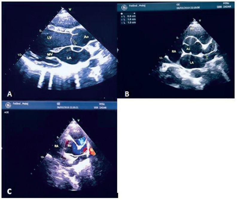 Kawasaki Disease Shock Syndrome Presented with Giant Coronary Artery Dilatation - Presentation of Two Cases and a Literature Review.