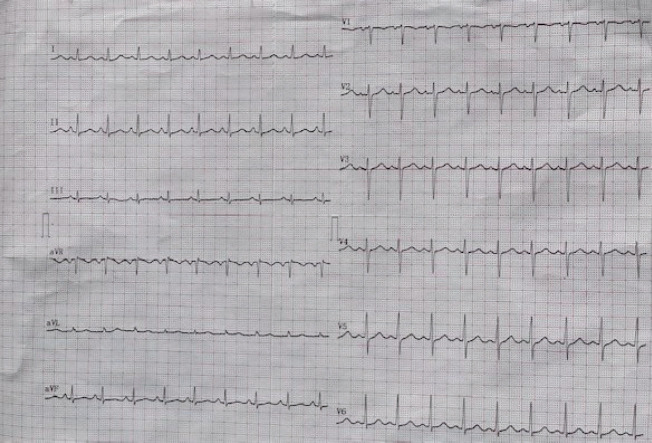 Kawasaki Disease Shock Syndrome Presented with Giant Coronary Artery Dilatation - Presentation of Two Cases and a Literature Review.