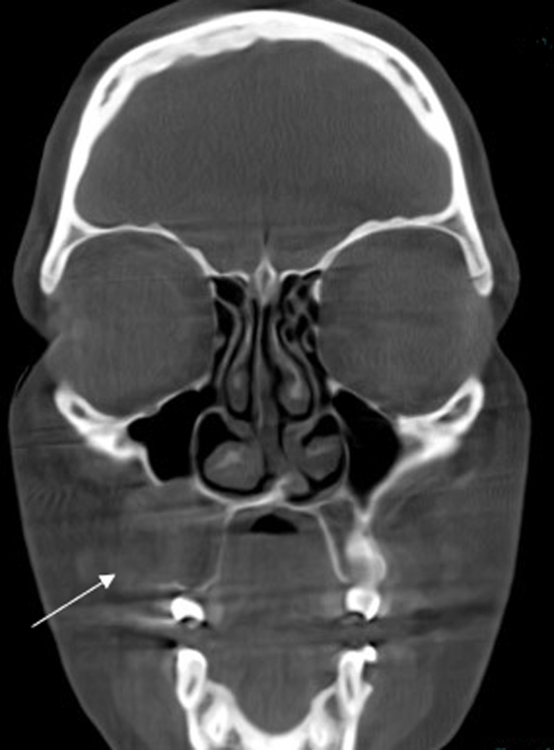 A Rare Case of Cemento-Ossifying Fibroma of the Maxilla.