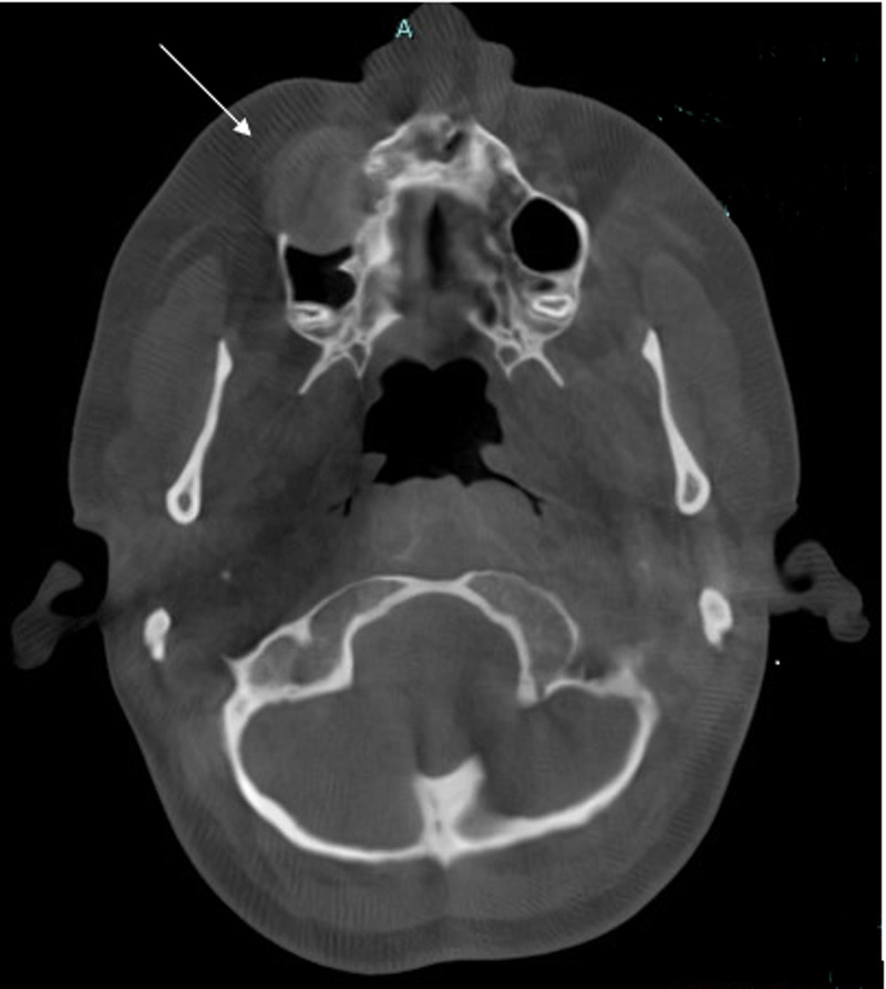 A Rare Case of Cemento-Ossifying Fibroma of the Maxilla.