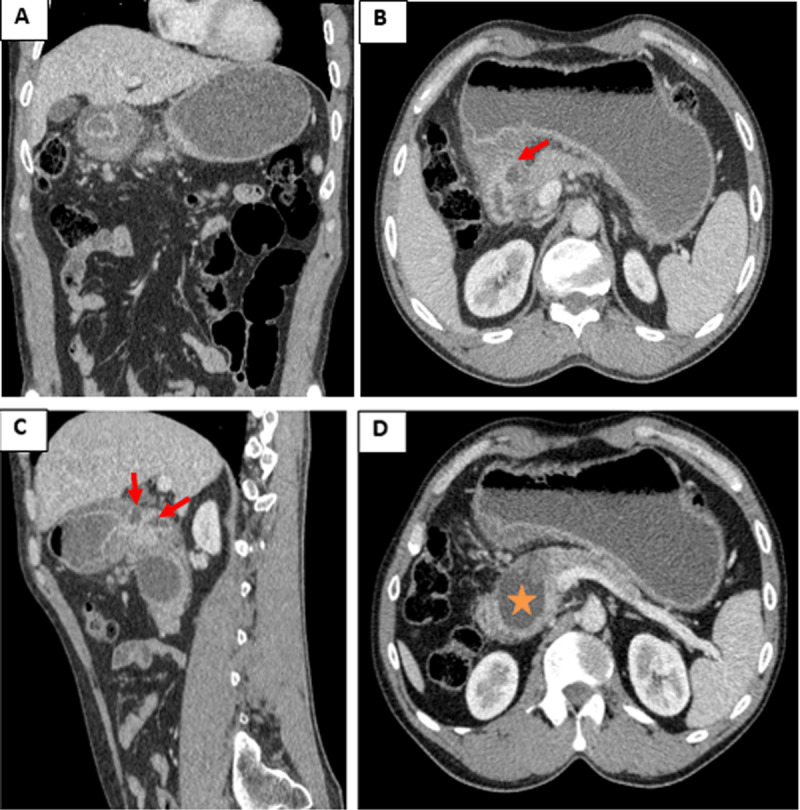 Cystic Dystrophy of the Duodenal Wall with Underlying Heterotopic Pancreas.