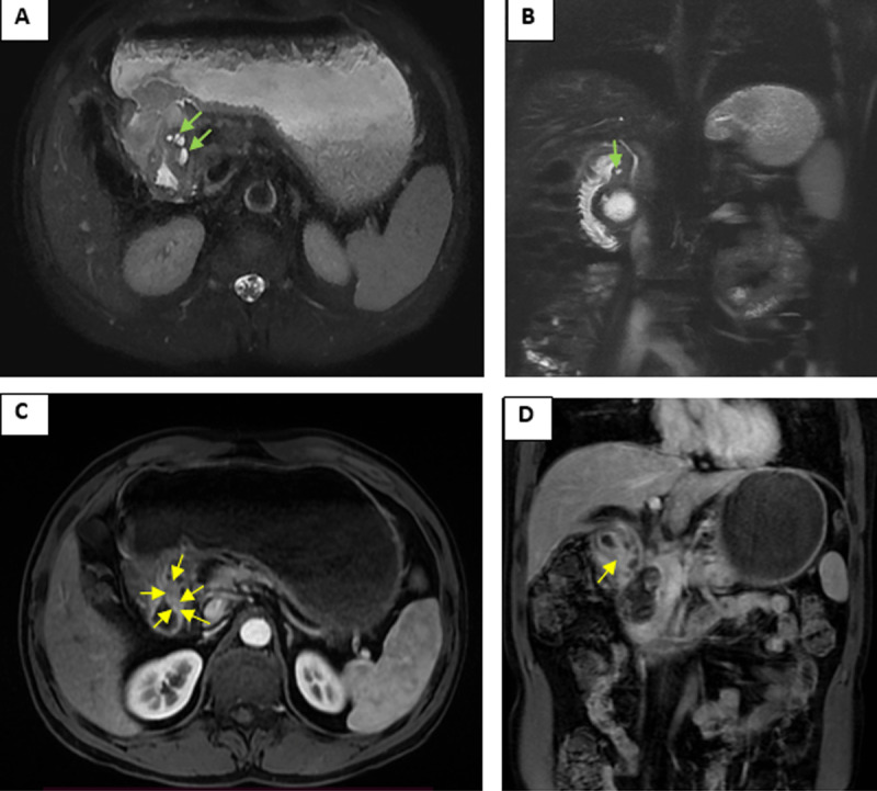 Cystic Dystrophy of the Duodenal Wall with Underlying Heterotopic Pancreas.