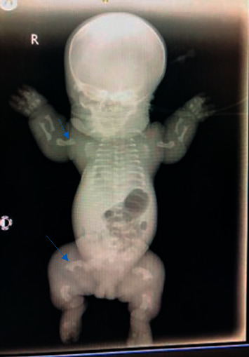 Thanatophoric Dysplasia: A Report of 2 Cases with Antenatal Misdiagnosis.