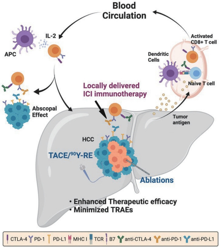 Combination of interventional oncology local therapies and immunotherapy for the treatment of hepatocellular carcinoma.