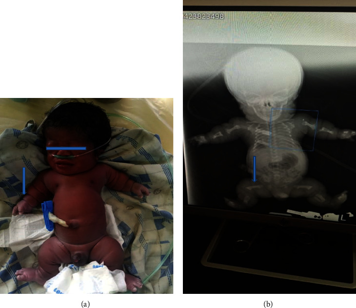 Thanatophoric Dysplasia: A Report of 2 Cases with Antenatal Misdiagnosis.