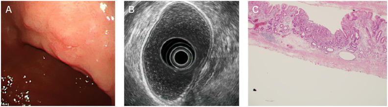 Accuracy of Endoscopic Ultrasonography for Determining the Depth of Invasion in Early Gastric Cancer.