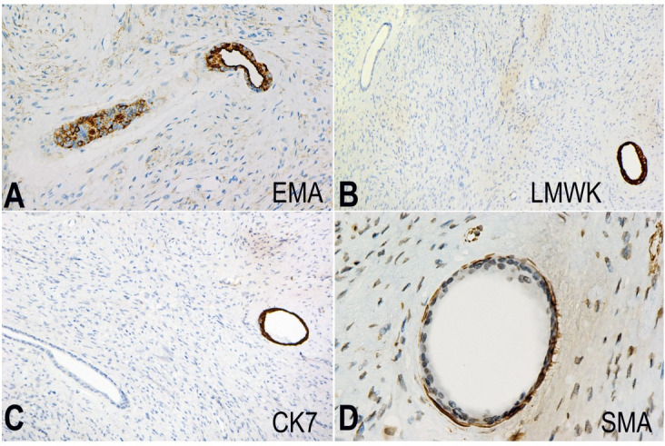 Benign glandular schwannoma.