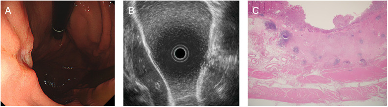 Accuracy of Endoscopic Ultrasonography for Determining the Depth of Invasion in Early Gastric Cancer.