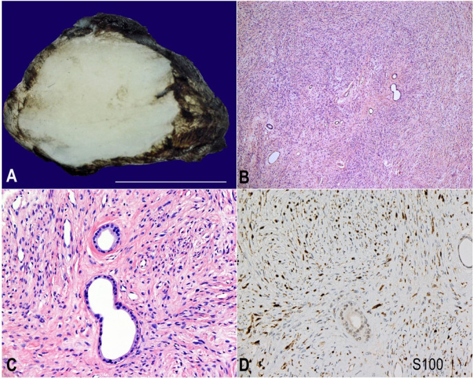 Benign glandular schwannoma.