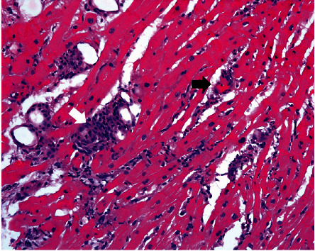 Achalasia as an Unusual Cause of Acute Cellular Rejection of a Transplanted Heart.