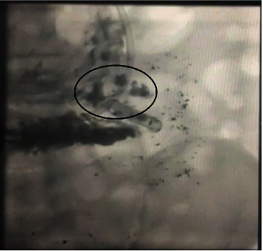 Achalasia as an Unusual Cause of Acute Cellular Rejection of a Transplanted Heart.