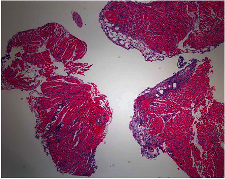 Achalasia as an Unusual Cause of Acute Cellular Rejection of a Transplanted Heart.