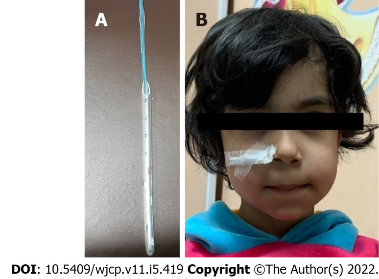 Utilization of chest tube as an esophagus stent in pediatric caustic injuries: A retrospective study.