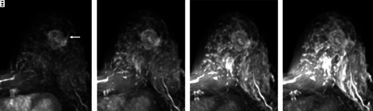 The value of adjacent vessel sign in malignant breast tumors.