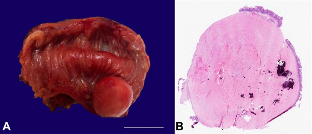 Calcifying fibrous tumor.