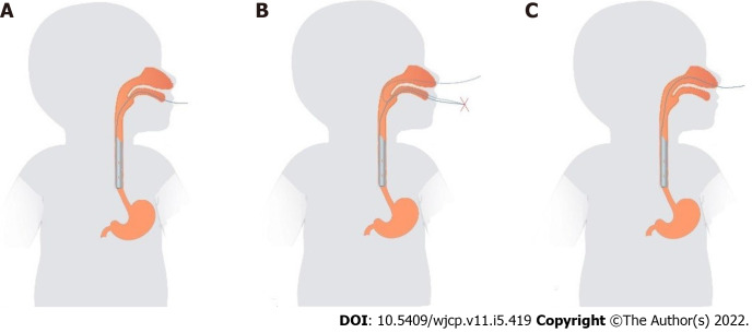 Utilization of chest tube as an esophagus stent in pediatric caustic injuries: A retrospective study.