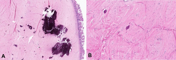 Calcifying fibrous tumor.