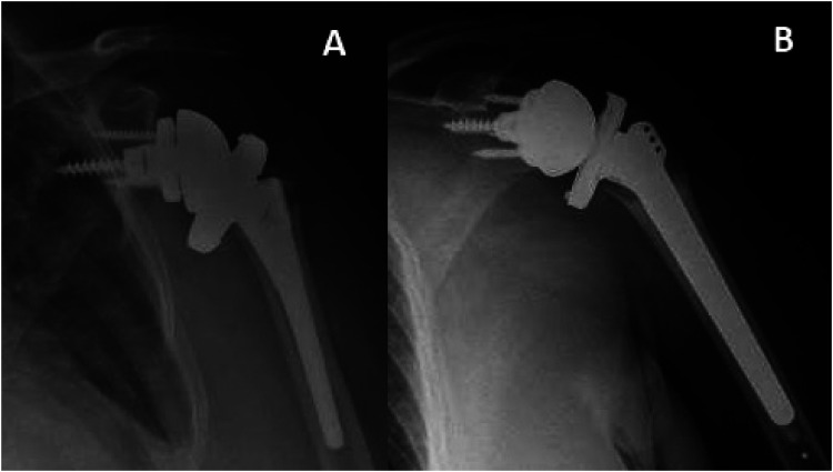 Outcomes of Reverse Total Shoulder Arthroplasty for Proximal Humerus Fracture Using Uncemented Stems, a Single Center Study.