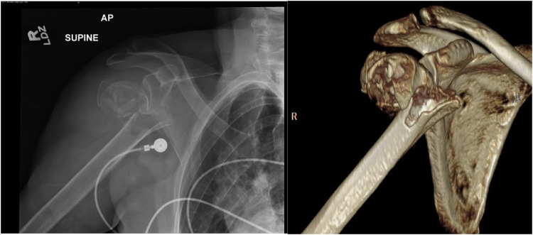 Outcomes of Reverse Total Shoulder Arthroplasty for Proximal Humerus Fracture Using Uncemented Stems, a Single Center Study.