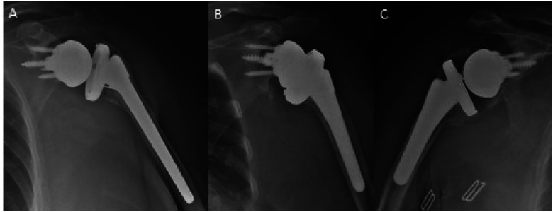 Outcomes of Reverse Total Shoulder Arthroplasty for Proximal Humerus Fracture Using Uncemented Stems, a Single Center Study.