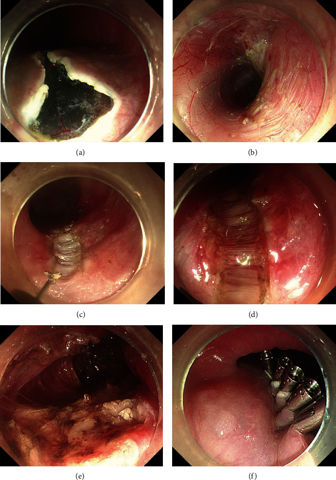 Safety and Efficacy of the Supine Position with the Right Shoulder Raised versus the Left Lateral Position in Peroral Endoscopic Myotomy for Achalasia: A Large-Sample Retrospective Study.