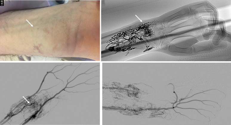 Image-guided embolization of arteriovenous malformations of the hand using Ethylene-vinyl Alcohol Copolymer.