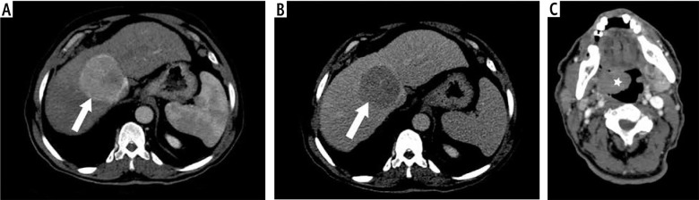 Multi-detector computed tomography evaluation of synchronous hepatocellular carcinoma and other solid malignancies.