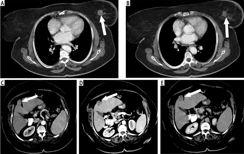 Multi-detector computed tomography evaluation of synchronous hepatocellular carcinoma and other solid malignancies.