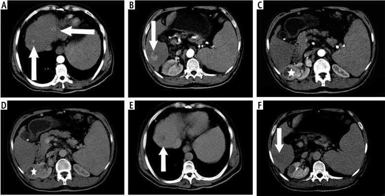 Multi-detector computed tomography evaluation of synchronous hepatocellular carcinoma and other solid malignancies.