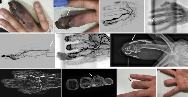 Image-guided embolization of arteriovenous malformations of the hand using Ethylene-vinyl Alcohol Copolymer.