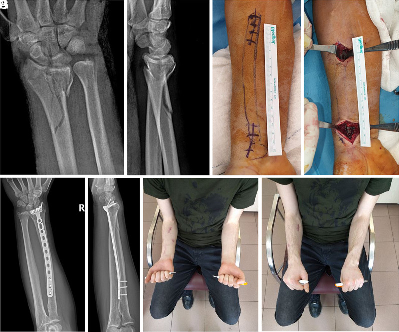 Is single-stage minimally invasive plate fixation safe in open distal radius fractures with metadiaphyseal involvement?: Retrospective evaluation of 54 patients.