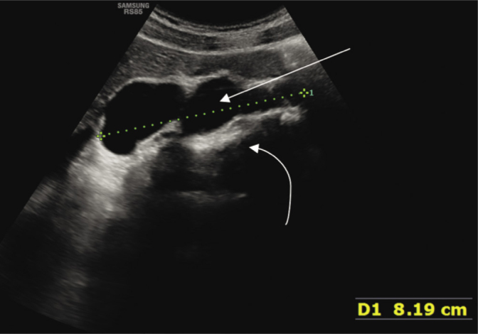 Enlarged Cisterna Chyli Diagnosed with Ultrasonography - Case Report.