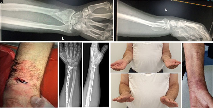 Is single-stage minimally invasive plate fixation safe in open distal radius fractures with metadiaphyseal involvement?: Retrospective evaluation of 54 patients.