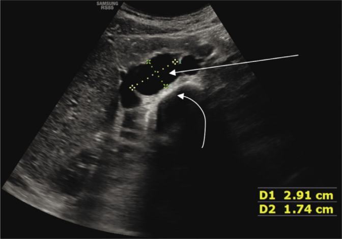 Enlarged Cisterna Chyli Diagnosed with Ultrasonography - Case Report.