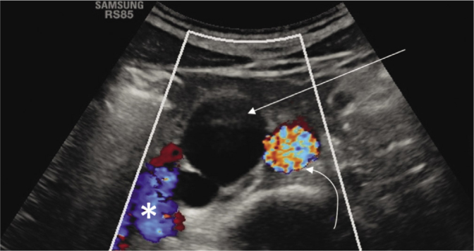 Enlarged Cisterna Chyli Diagnosed with Ultrasonography - Case Report.