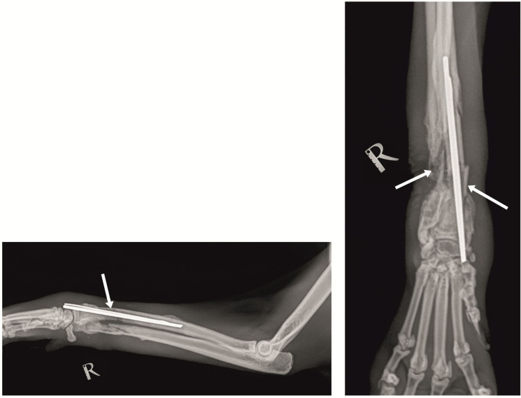 Successful outcome of distal radius non-union after open fracture osteomyelitis treated by external fixation and bone grafting in a cat: case report.