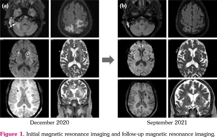 Remote intracranial granulomas in granulomatosis with polyangiitis.