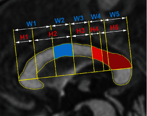 Comorbid Neurodegeneration in Primary Progressive Aphasia: Clinicopathological Correlations in a Single-Center Study.