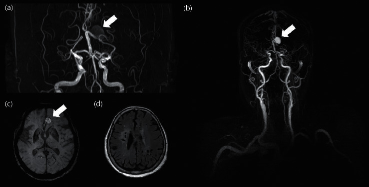 Long-Lasting Unruptured Large Intracranial Aneurysm in Bilateral Moyamoya Disease: Case Report.