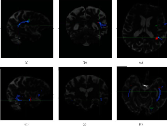 Comorbid Neurodegeneration in Primary Progressive Aphasia: Clinicopathological Correlations in a Single-Center Study.