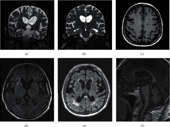 Comorbid Neurodegeneration in Primary Progressive Aphasia: Clinicopathological Correlations in a Single-Center Study.