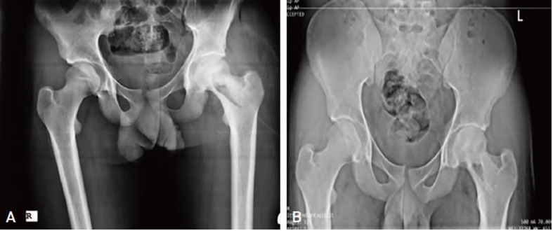 <i>Klebsiella pneumoniae</i> and <i>Enterobacter cloacae</i> Induced Septic Arthritis in a Healthy Adolescent: A Rare Case Report.