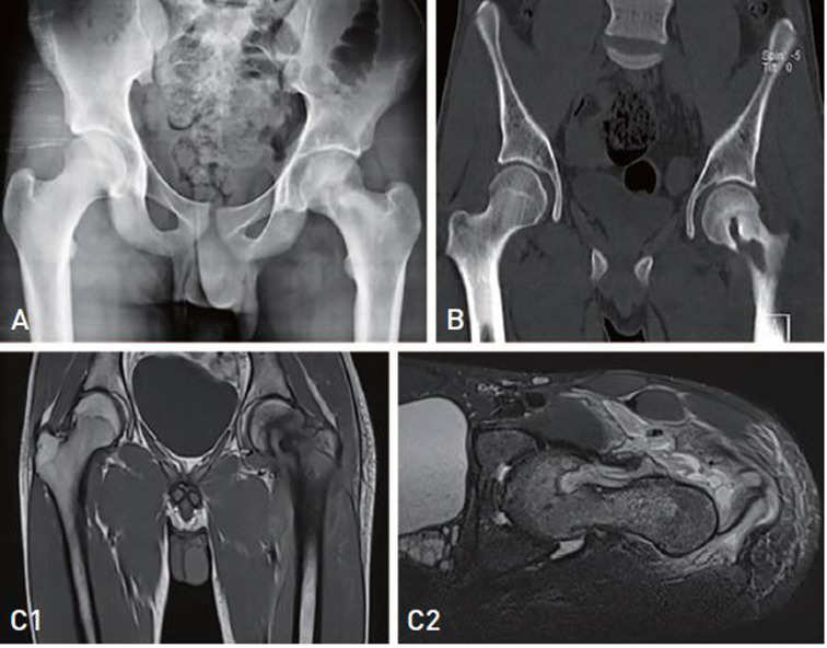 <i>Klebsiella pneumoniae</i> and <i>Enterobacter cloacae</i> Induced Septic Arthritis in a Healthy Adolescent: A Rare Case Report.