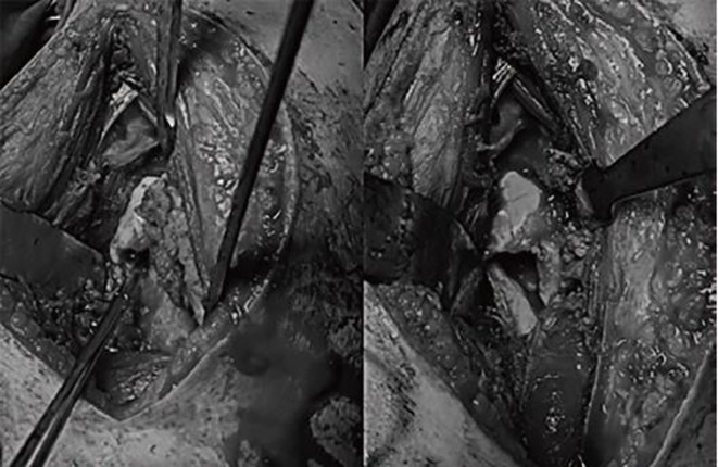 <i>Klebsiella pneumoniae</i> and <i>Enterobacter cloacae</i> Induced Septic Arthritis in a Healthy Adolescent: A Rare Case Report.