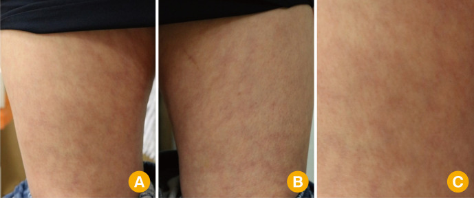 Livedo reticularis following administration of ChAdOx1 nCoV-19 vaccine (AZD1222): a report of two cases.