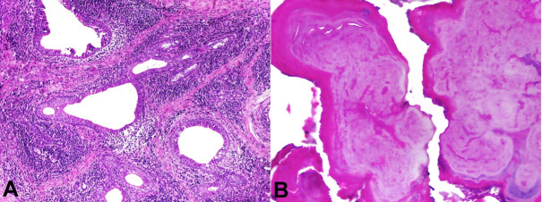 Suppurative minor salivary gland sialolithiasis.